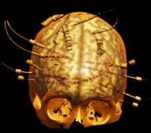 Escáner del cerebro con los electrodos que usan los médicos para localizar el origen de los problemas epilépticos. Escáner del cerebro con los electrodos que usan los médicos para localizar el origen de los problemas epilépticos.