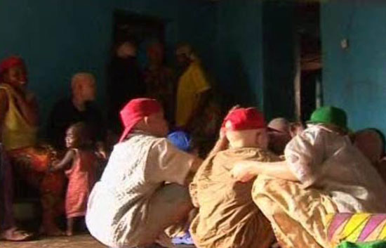 Al menos treinta albinos han sido asesinados en Tanzania y Burundi este a&ntilde;o