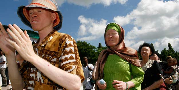 Albinos en Tanzania Albinos en Tanzania