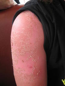 Quemadura solar en un brazo