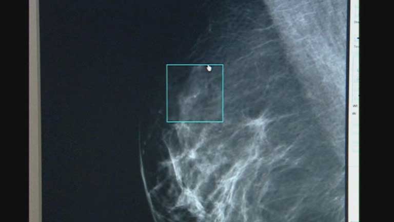Un grupo de investigadores perfeccionan el diagnóstico de los tumores de mama