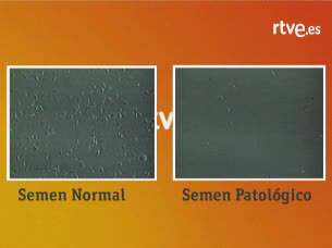 Ver v&iacute;deo  'C&oacute;mo es el semen normal y el patol&oacute;gico'