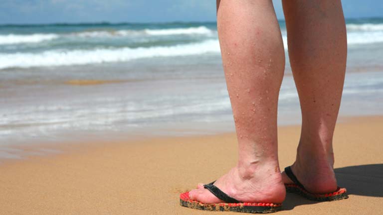 Consejos para las varices en verano - La ma&ntilde;ana de La 1