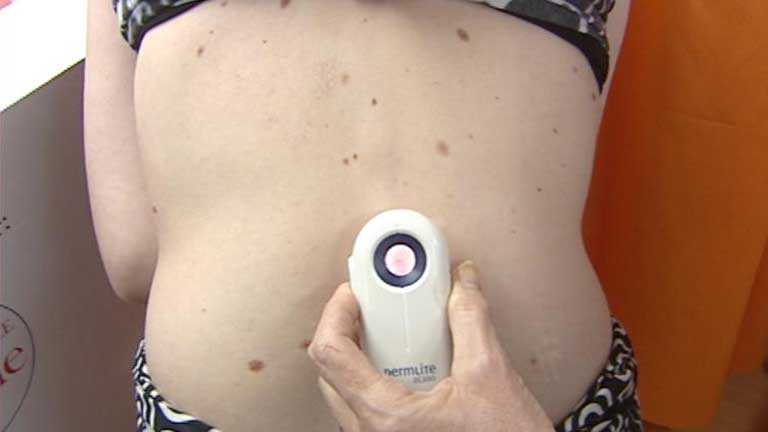 Hoy es el d&iacute;a europeo del Melanoma