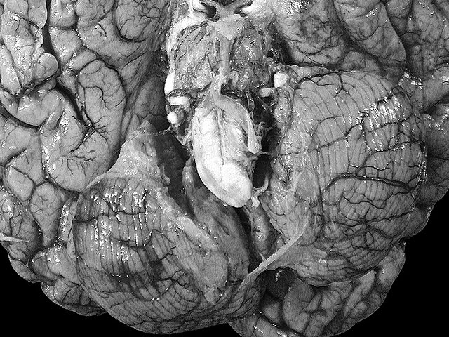 D&iacute;a Mundial del Parkinson (En Saber Vivir)