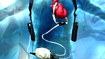Ir al Video&nbsp;Documentos TV - Corazones artificiales. Impulsos de vida - Avance