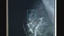 Ir al Video&nbsp;Un grupo de investigadores perfeccionan el diagn&oacute;stico de los tumores de mama