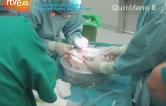 Un hospital madrile&ntilde;o innova con un sistema para curar "pulmones que era impensable trasplantar"
