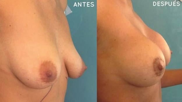 Lipotrasnferencia Lipotrasnferencia