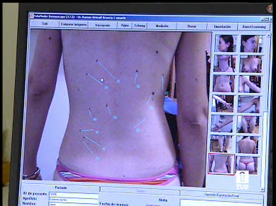 Ver v&iacute;deo  'El melanoma provoca la muerte cada a&ntilde;o a unas 700 personas en Espa&ntilde;a'