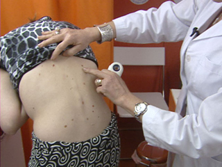 Ver v&iacute;deo  'El melanoma es el tipo de c&aacute;ncer que m&aacute;s aumenta cada a&ntilde;o, hasta un 10%'