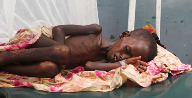 Un niño somalí con malnutrición descansa en el hospital Banadir al sur de Mogadiscio Un niño somalí con malnutrición descansa en el hospital Banadir al sur de Mogadiscio