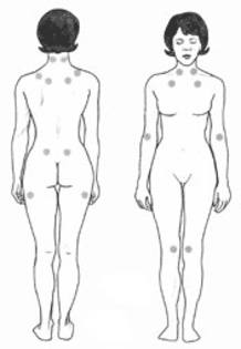 Los círculos son reconocidos como puntos sensibles comunes asociados con la fibromialgia. Los círculos son reconocidos como puntos sensibles comunes asociados con la fibromialgia.
