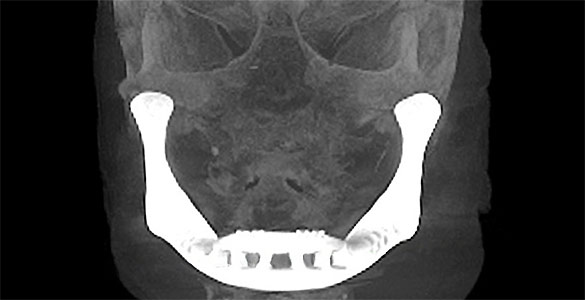Radiografía de la mandíbula artificial implantada en la paciente