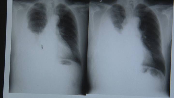 Placa de rayos X con mesioteloma, cáncer de pleura, enfermedad exclusiva de la exposición al amianto